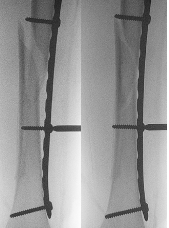 Bridge plating paediatric femur fracture